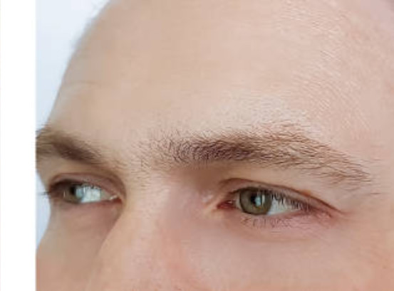 Botox forehead lines – after treatment, smooth natural skin