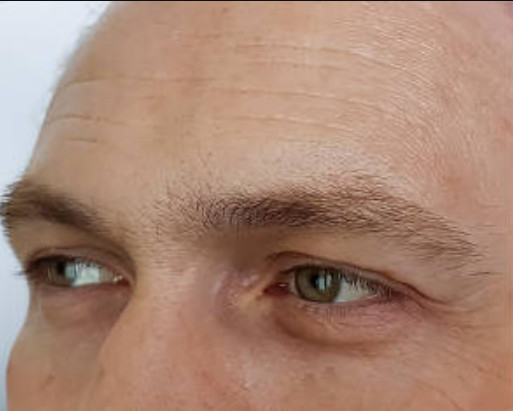 Before Botox forehead lines – before treatment